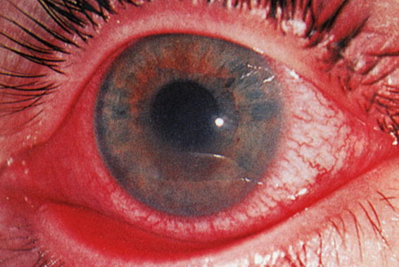Увеит (воспаление сосудистой глазной оболочки) при артрите у детей