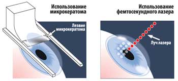 ФемтоSuperLasik