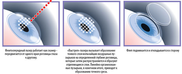 ФемтоSuperLasik