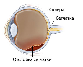 отслоение сетчатки