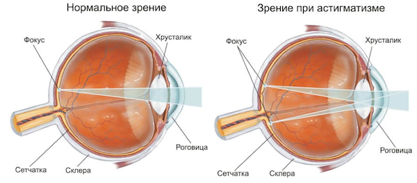 Доклад по теме Астигматизм