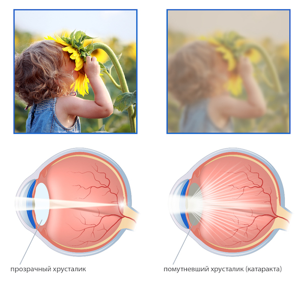 катаракта причины симптомы лечение и профилактика