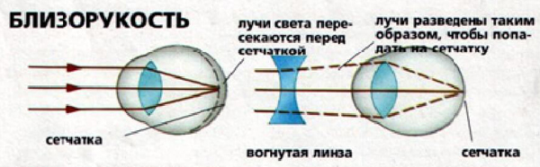 Близорукость и дальнозоркость подбор очков