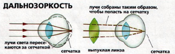 Близорукость и дальнозоркость подбор очков