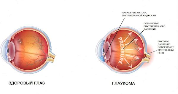 Что такое ГЛАУКОМА