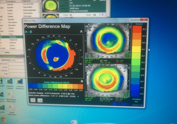 Обследование роговицы на кератотопографе.