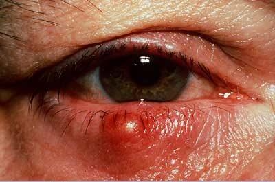 Ячмень на глазу Ячмень на глазу