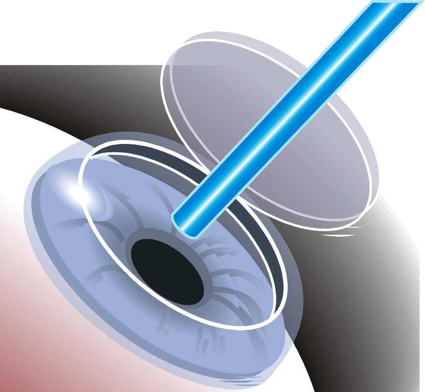 ЛАСИК (LASIK) ЛАСИК (LASIK)