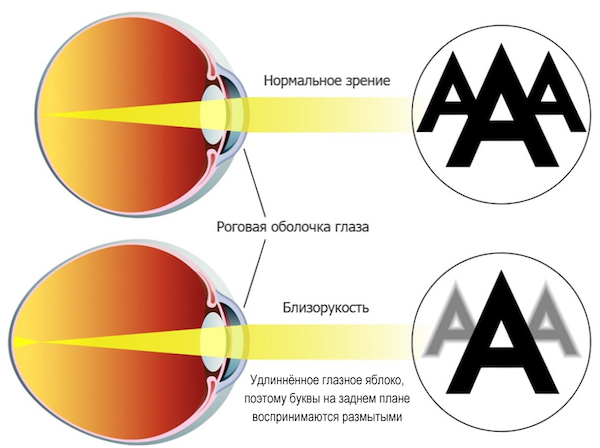 Подбор очков при близорукости Подбор очков при близорукости